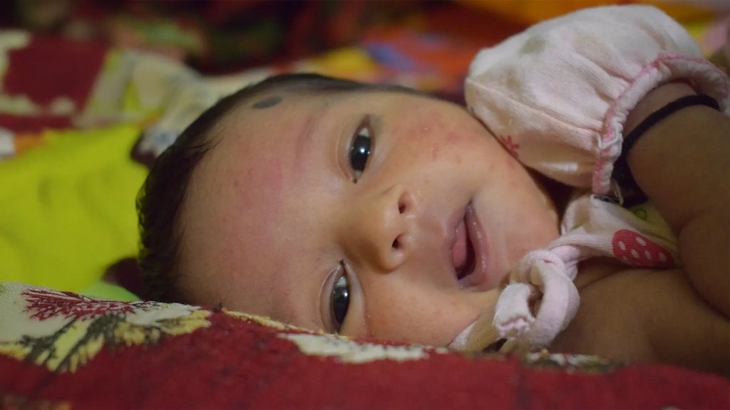 Common Causes of Baby Eczema