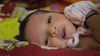 Common Causes of Baby Eczema