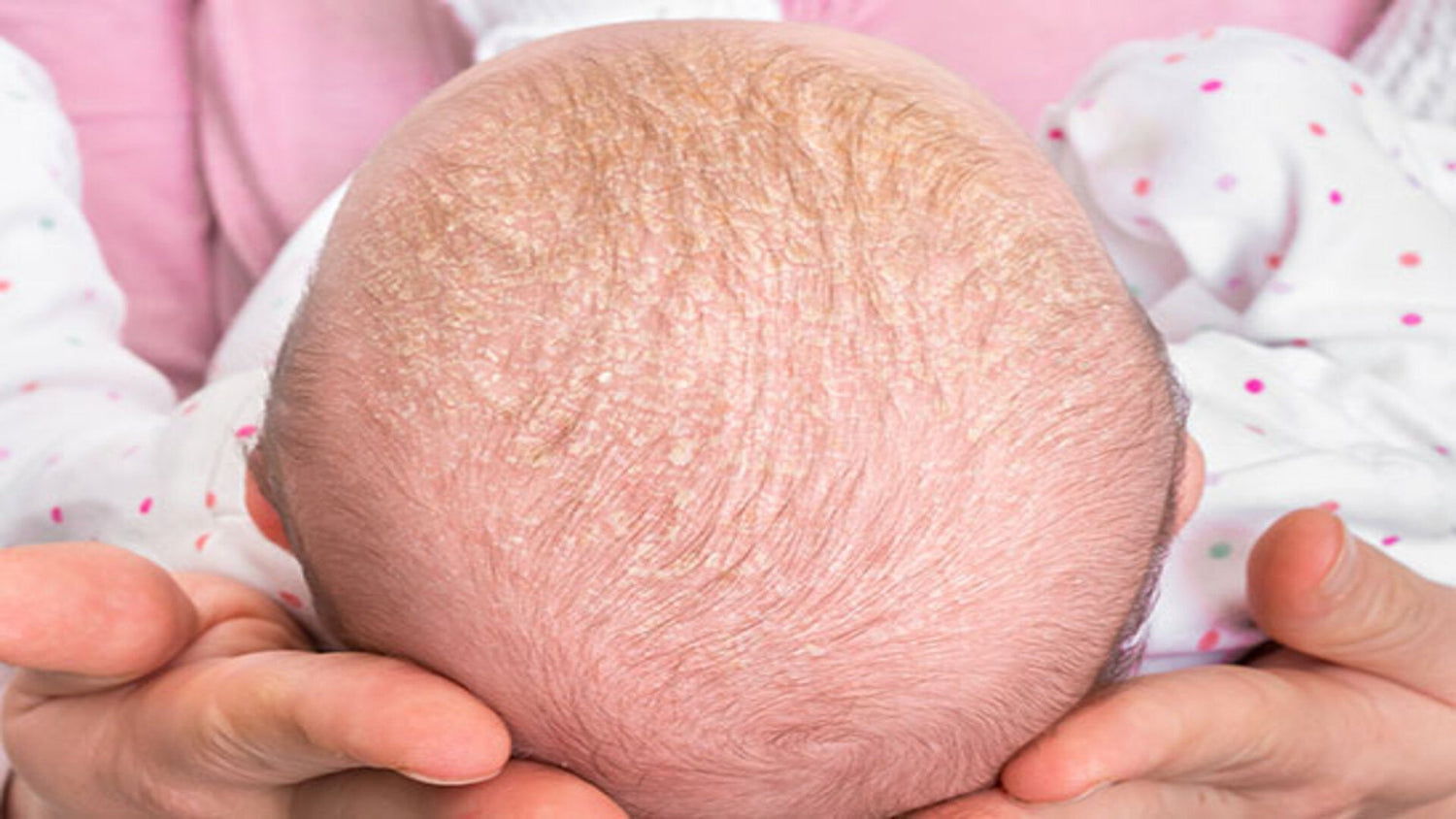 Cradle Cap; Baby Scalp Condition