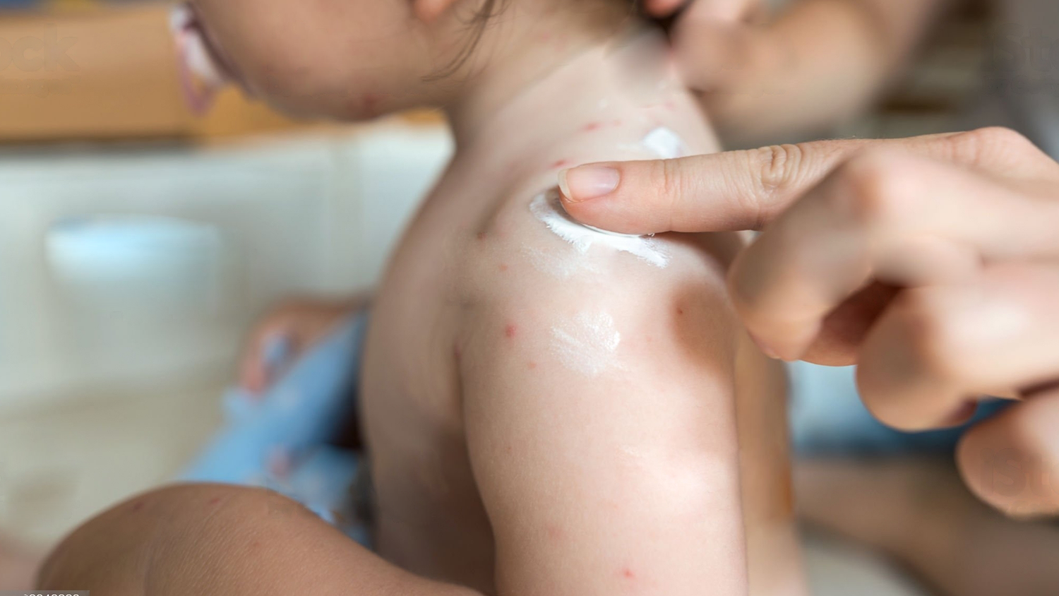 Common Skin Conditions in Babies