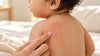 Baby Acne, Milia, Heat Rash or Eczema? A Parent’s Guide to Common Baby Skin Changes