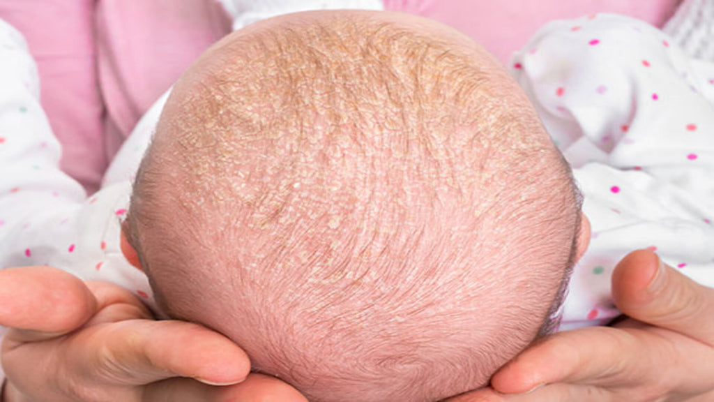 Cradle Cap; Baby Scalp Condition