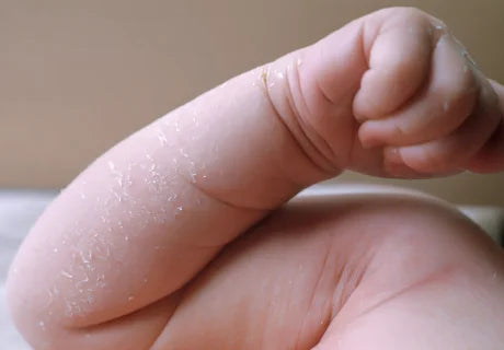 What Harsh Soaps Can Do