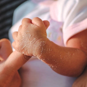 Dry Skin
