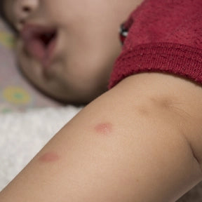 Mosquito Bites