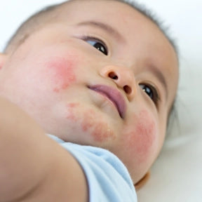 Baby Rashes