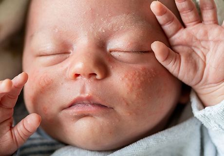 Baby’s Skin Sensitivity 